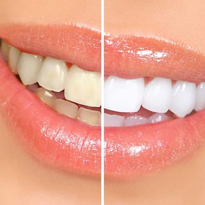 Dentures
