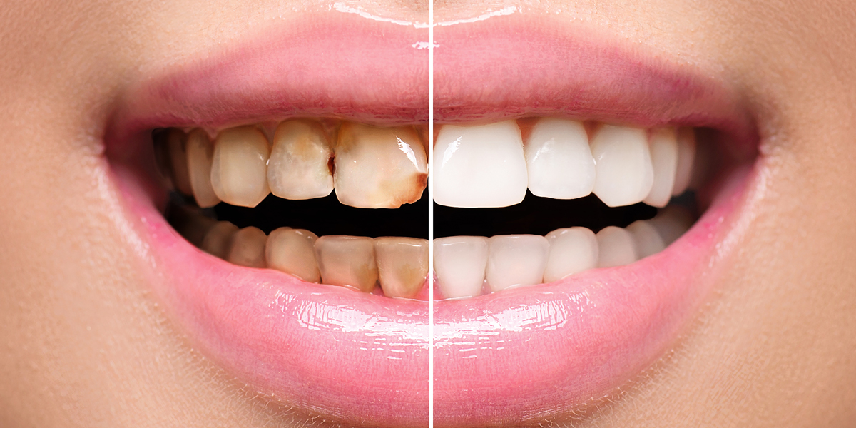 Dentures